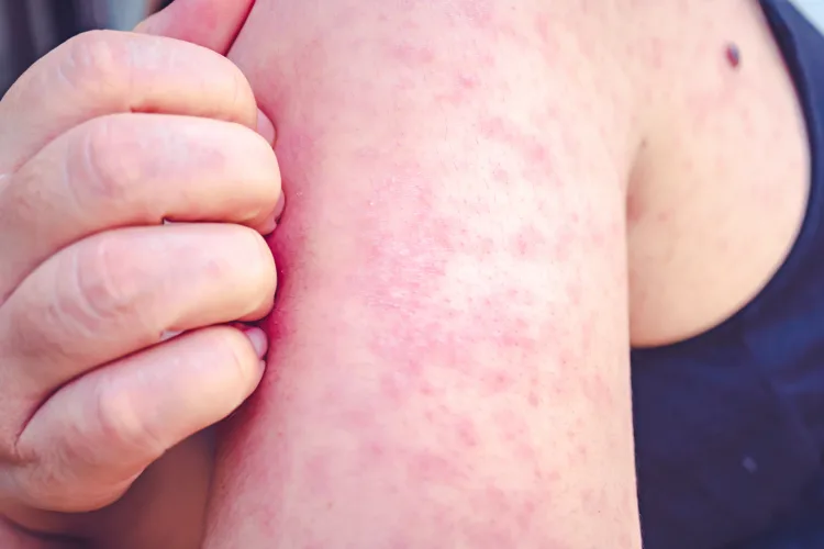 Measles outbreak grows in southwest Wisconsin